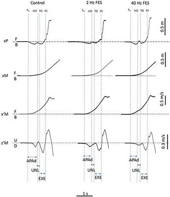 In Patients With Parkinson’s Disease in an OFF-Medication State, Does Bilateral Electrostimulation of Tibialis Anterior Improve Anticipatory Postural Adjustments During Gait Initiation?